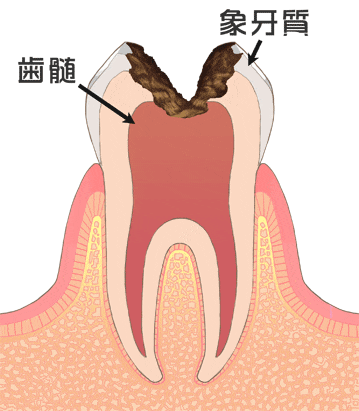 虫歯の後期（神経まで進行した虫歯）