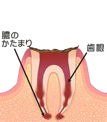 虫歯の末期（歯の根まで進行した虫歯）