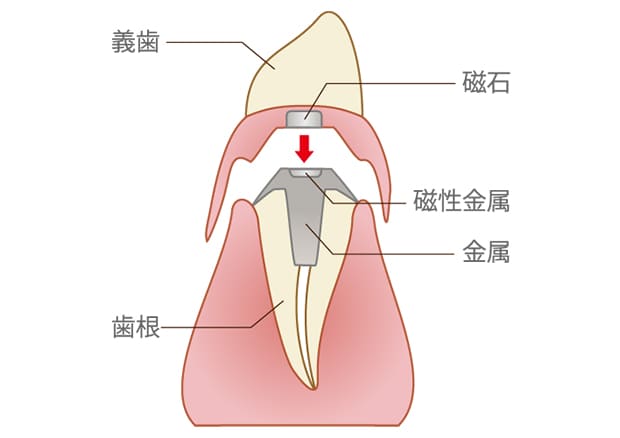 アタッチメント義歯