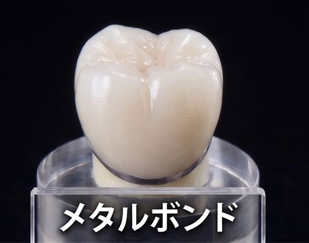 メタルボンド