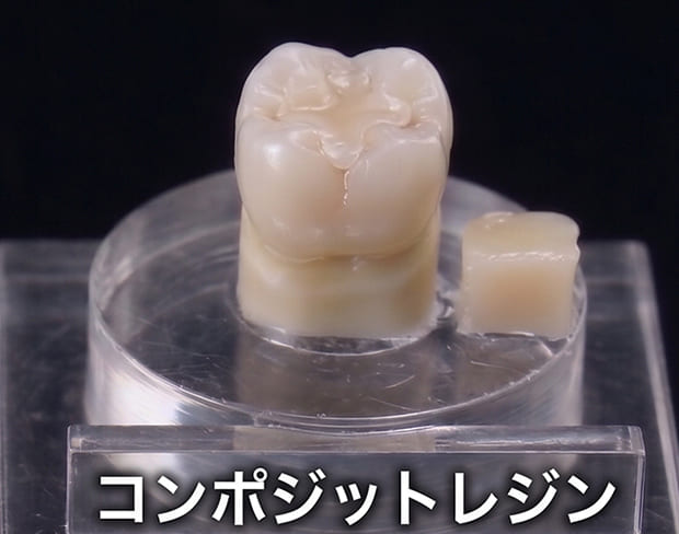 コンポジットレジン