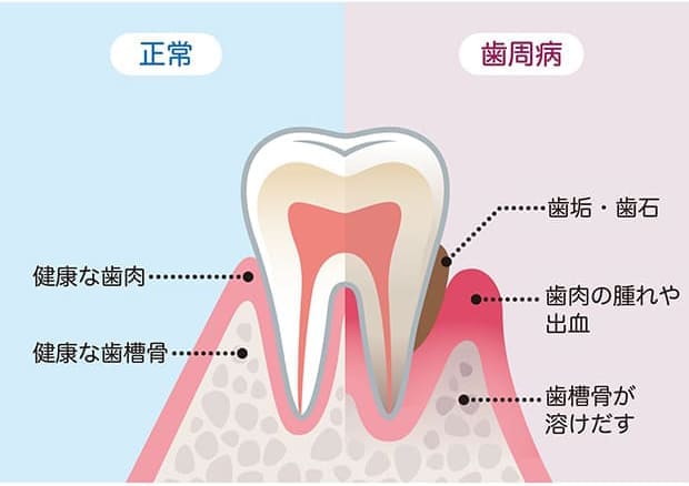 気づきにくく、静かに進む歯周病