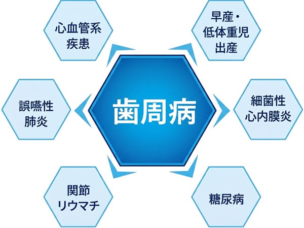 歯周病が全身の病気に及ぼす影響
