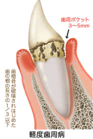 軽度歯周病（危険度★★）
