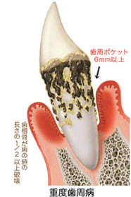 重度歯周病（危険度★★★★★）