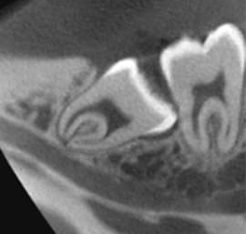 3D画像で捉える、精密親知らず抜歯